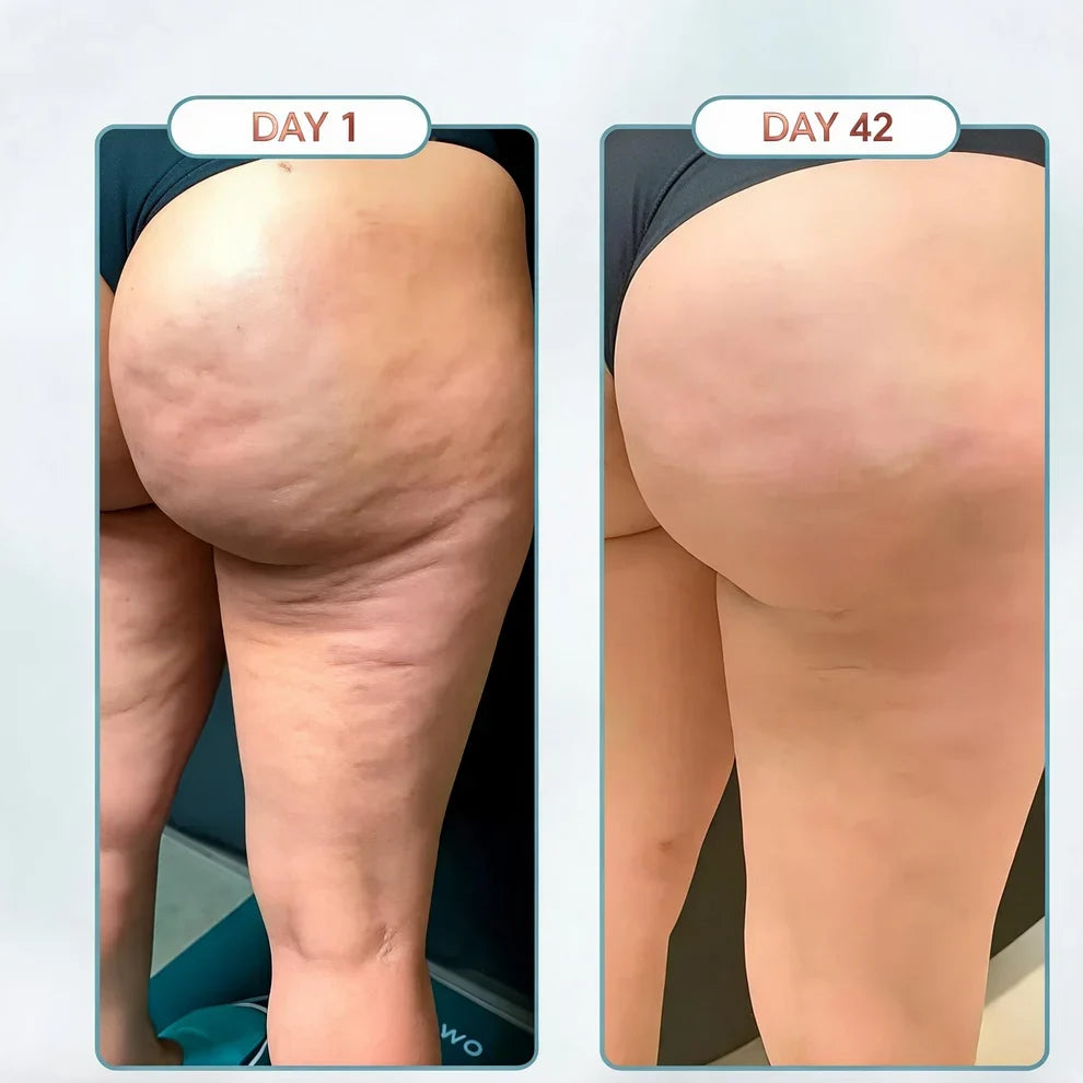 🔥 Handheld Cellulite & Body Vacuum Massager – 12-Level Electric Leg & Thigh Massager 🦵✨